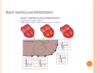 RIGHT VENTRICULAR HYPERTROPHY
 