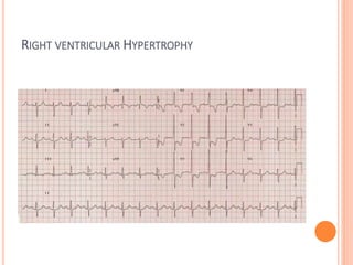 RIGHT VENTRICULAR HYPERTROPHY
 