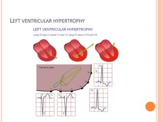 LEFT VENTRICULAR HYPERTROPHY
 