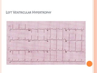 LEFT VENTRICULAR HYPERTROPHY
 