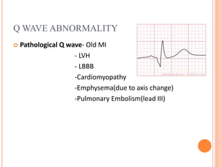 Q WAVE ABNORMALITY
 Pathological Q wave- Old MI
- LVH
- LBBB
-Cardiomyopathy
-Emphysema(due to axis change)
-Pulmonary Embolism(lead III)
 