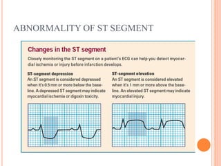 ABNORMALITY OF ST SEGMENT
 