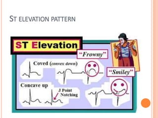 ST ELEVATION PATTERN
 