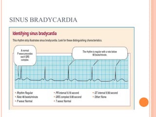 SINUS BRADYCARDIA
 