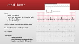 ECG basics an introduction to rhythm recognition | PPTX