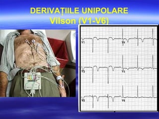 DERIVAŢIILE UNIPOLARE
Vilson (V1-V6)
 