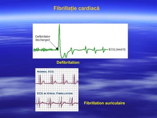 Defibrilation
Fibrillaţie cardiacă
Fibrillation auriculaire
 