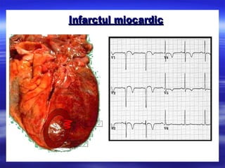 ECG: electrocardiograma
