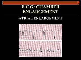 E C G: CHAMBER ENLARGEMENT ATRIAL ENLARGEMENT 