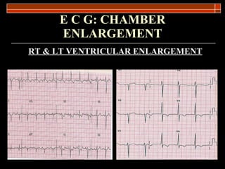 E C G: CHAMBER   ENLARGEMENT RT & LT VENTRICULAR ENLARGEMENT 