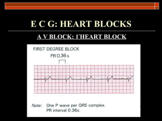 E C G: HEART BLOCKS A V BLOCK: 1 º HEART BLOCK 