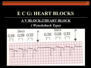 E C G: HEART BLOCKS A V   BLOCK:2 º HEART BLOCK ( Wenckebach Type) 