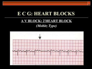 E C G: HEART BLOCKS A V BLOCK: 2 º HEART BLOCK (Mobitz Type) 