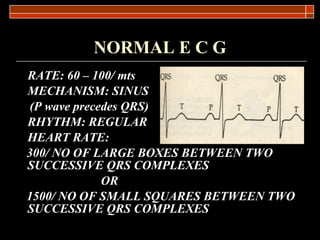 NORMAL E C G RATE: 60 – 100/ mts MECHANISM: SINUS (P wave precedes QRS)  RHYTHM: REGULAR HEART RATE: 300/ NO OF LARGE BOXES BETWEEN TWO SUCCESSIVE QRS COMPLEXES OR 1500/ NO OF SMALL SQUARES BETWEEN TWO SUCCESSIVE QRS COMPLEXES  