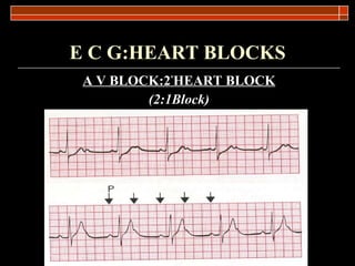 E C G:HEART BLOCKS A V BLOCK:2 º HEART BLOCK (2:1Block) 
