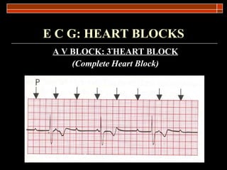 E C G: HEART BLOCKS A V BLOCK: 3 º HEART BLOCK (Complete Heart Block) 
