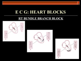 E C G: HEART BLOCKS RT BUNDLE BRANCH BLOCK 