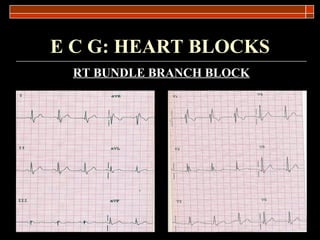 E C G: HEART BLOCKS RT BUNDLE BRANCH BLOCK 