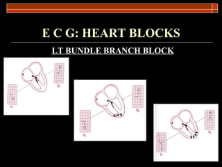 E C G: HEART BLOCKS LT BUNDLE   BRANCH BLOCK 
