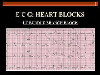 E C G: HEART BLOCKS LT BUNDLE BRANCH BLOCK 