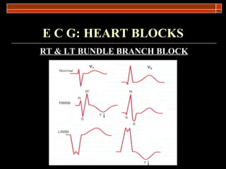 E C G:   HEART BLOCKS RT & LT BUNDLE BRANCH BLOCK 