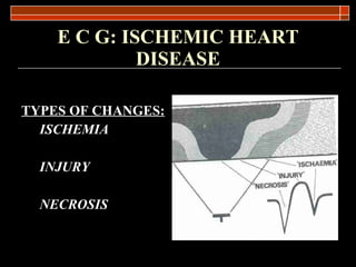 E C G: ISCHEMIC HEART DISEASE TYPES OF CHANGES: ISCHEMIA INJURY NECROSIS 