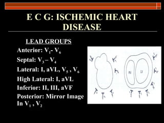 E C G: ISCHEMIC HEART DISEASE LEAD GROUPS Anterior: V 1 - V 6 Septal: V 3  – V 4 Lateral: I, aVL, V 5  , V 6 High Lateral: I, aVL Inferior: II, III, aVF Posterior: Mirror Image In V 1  , V 2 