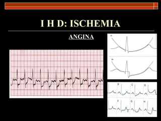I H D: ISCHEMIA ANGINA 