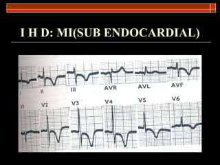 I H D: MI(SUB ENDOCARDIAL) 
