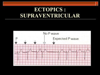 ECTOPICS : SUPRAVENTRICULAR 