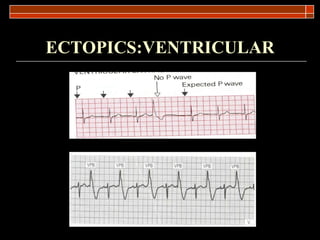ECTOPICS:VENTRICULAR 