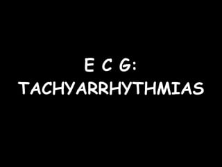 E C G: TACHYARRHYTHMIAS 