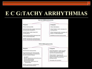 E C G:TACHY ARRHYTHMIAS 