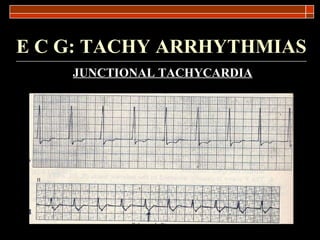 E C G: TACHY ARRHYTHMIAS JUNCTIONAL TACHYCARDIA 