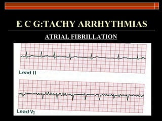 E C G:TACHY ARRHYTHMIAS ATRIAL FIBRILLATION 