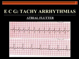 E C G: TACHY ARRHYTHMIAS ATRIAL FLUTTER 