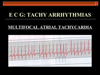 E C G: TACHY ARRHYTHMIAS MULTIFOCAL ATRIAL TACHYCARDIA 