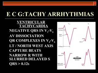 E C G:TACHY ARRHYTHMIAS VENTRICULAR TACHYCARDIA NEGATIVE QRS IN V 1 -V 6   AV DISSOCIATION QR COMPLEXES IN V 4 -V 6 LT / NORTH WEST AXIS CAPTURE BEATS NARROW R WITH SLURRED DELAYED S QRS > 0.12s 