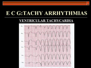 E C G:TACHY ARRHYTHMIAS VENTRICULAR TACHYCARDIA 