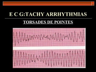 E C G:TACHY ARRHYTHMIAS TORSADES DE POINTES 