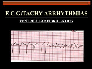 E C G:TACHY ARRHYTHMIAS VENTRICULAR FIBRILLATION   
