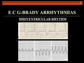E C G:BRADY ARRHYTHMIAS IDIOVENTRICULAR RHYTHM 