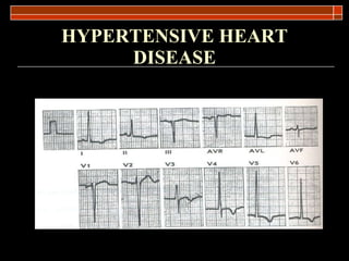 HYPERTENSIVE HEART DISEASE 