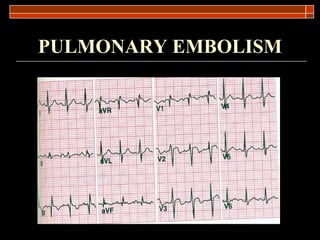 PULMONARY EMBOLISM 