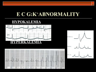E C G:K + ABNORMALITY HYPOKALEMIA HYPERKALEMIA 
