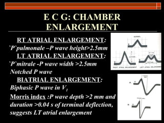 E C G: CHAMBER ENLARGEMENT RT ATRIAL ENLARGEMENT : `P`pulmonale –P wave height>2.5mm LT ATRIAL ENLARGEMENT : `P`mitrale -P wave width >2.5mm Notched P wave BIATRIAL ENLARGEMENT : Biphasic P wave in V 1 Morris index  : P wave depth >2 mm and duration >0.04 s of terminal deflection, suggests LT atrial enlargement 