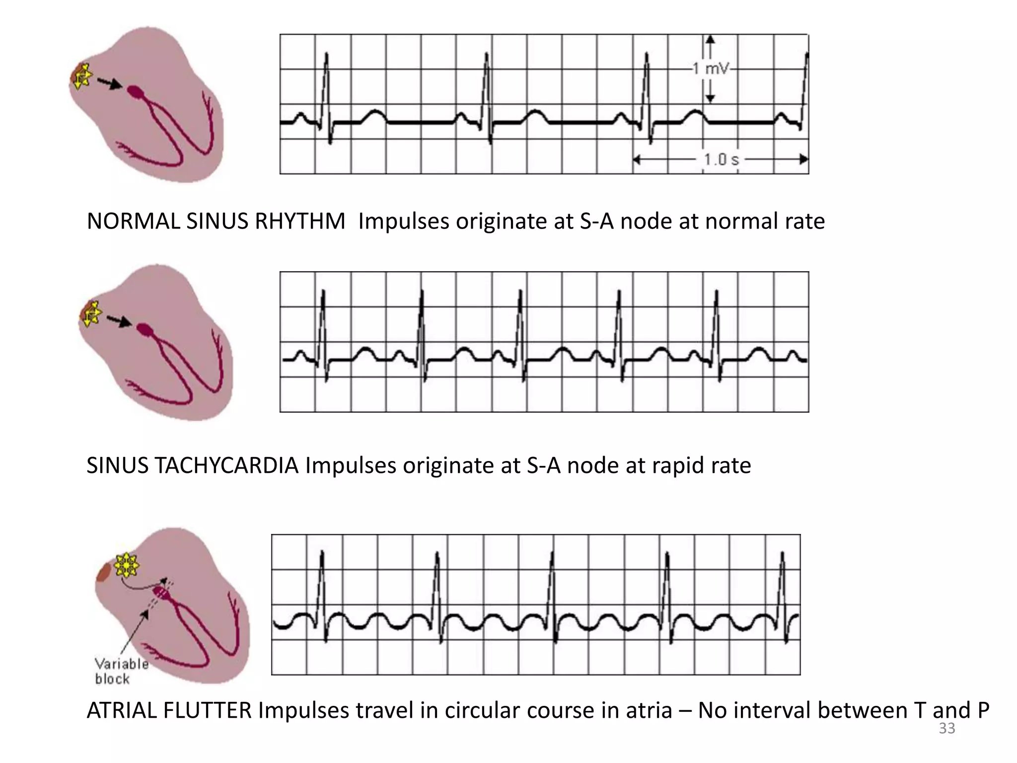 33
NORMAL SINUS RHYTHM Impulses originate at S-A node at normal rate
SINUS TACHYCARDIA Impulses originate at S-A node at rapid rate
ATRIAL FLUTTER Impulses travel in circular course in atria – No interval between T and P
 