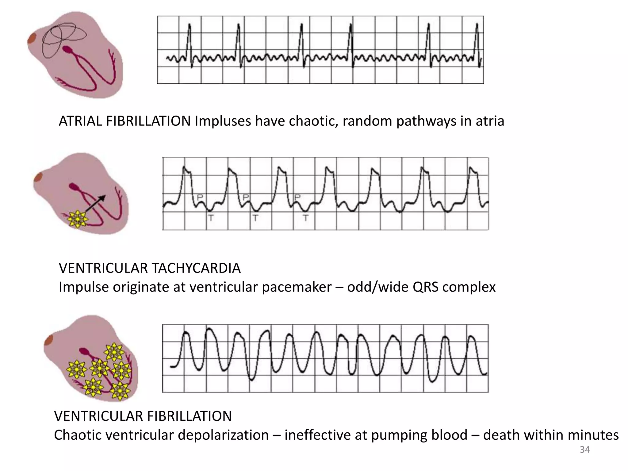 34
ATRIAL FIBRILLATION Impluses have chaotic, random pathways in atria
VENTRICULAR TACHYCARDIA
Impulse originate at ventricular pacemaker – odd/wide QRS complex
VENTRICULAR FIBRILLATION
Chaotic ventricular depolarization – ineffective at pumping blood – death within minutes
 