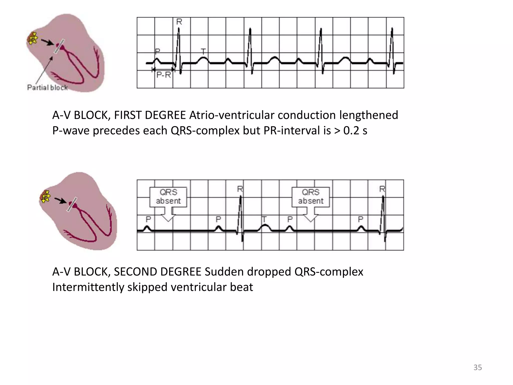 35
A-V BLOCK, FIRST DEGREE Atrio-ventricular conduction lengthened
P-wave precedes each QRS-complex but PR-interval is > 0.2 s
A-V BLOCK, SECOND DEGREE Sudden dropped QRS-complex
Intermittently skipped ventricular beat
 