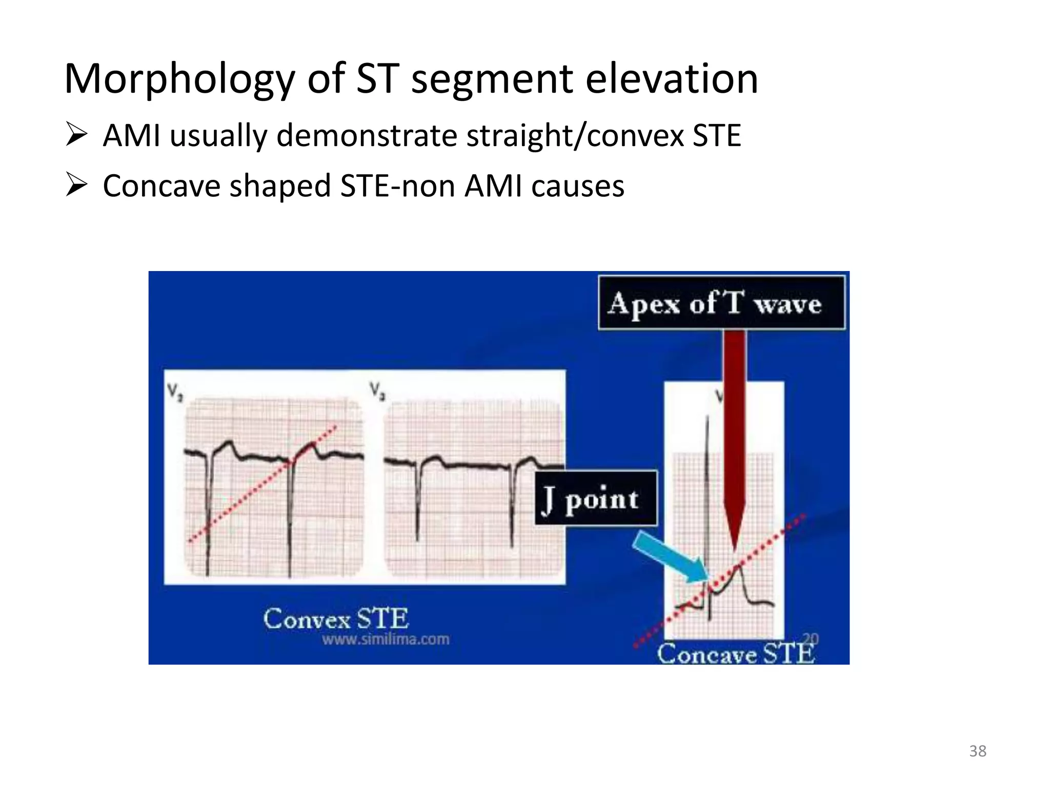 Morphology of ST segment elevation
 AMI usually demonstrate straight/convex STE
 Concave shaped STE-non AMI causes
38
 